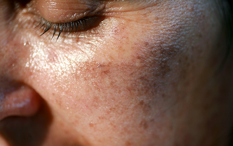 uv radiation effects on skin
